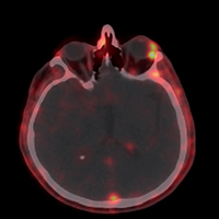 68Ga-citrate PET/CT showing a focal granuloma with distinctive uptake at the left anterior orbit
