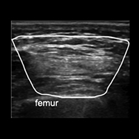 The muscles visualized by the ultrasound: Rectus femoris