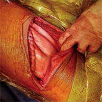 Final operative result demonstrating removal of the mass and reconstruction of the chest wall using Strattice™ tissue matrix