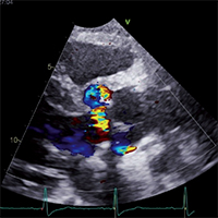 Echocardiographic evaluation of paravalvular aortic regurgitation of a ...