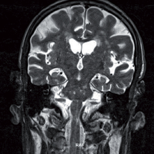Ischemic stroke in the pontine anterior and medianparamedian left regions at the brain MRI.