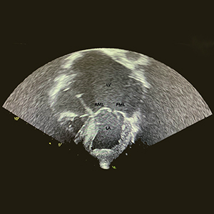 Echocardiography showing dilated left atrium and ventricle and non-coapting mitral valve leaflets.