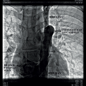 Antero-posterior fluoroscopic projection demonstrating left persistent inferior vena cava (LPIVC) continuing as hemiazygous vein (HAV), leading to left persistent superior vena cava (LSVC), draining into dilated coronary sinus.