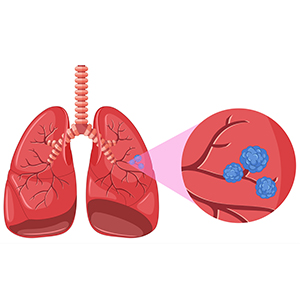<a href="https://www.vecteezy.com/free-vector/lung-cancer">Lung Cancer Vectors by Vecteezy</a>