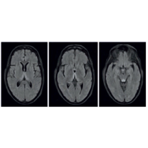 Cerebral MRI revealing a diffuse, bilateral and symmetric areas of increased T2 signal in the thalamus, hypothalamus and mamillary bodies, highly suggestive of Wernicke encephalopathy.